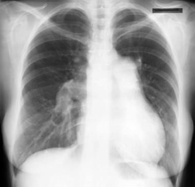 MCTD: klinikai megnyilvánulások 2. tüdő pleuritis ILD pulmonalis hypertonia szív pericarditis: akár tamponád!