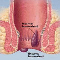 Nodi haemorrhoidales Tágult analis és perianalis vénás plexus Hajlamosít: Ülő foglalkozás, elhízás, székrekedés, terhesség,