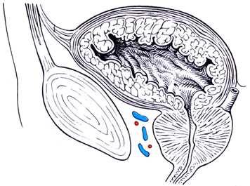 medialis a. epigastrica inf. elzáródott a.