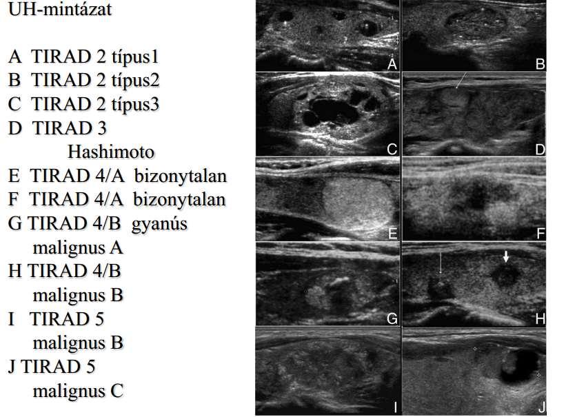 Thyroid Imaging Reporting and Data System