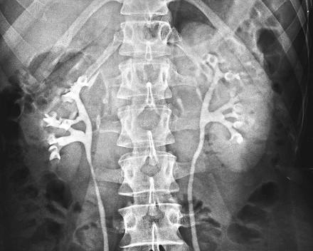 Pyelographia (A vesemedence kontrasztanyagos röntgen-vizsgálata; retrográd feltöltés) XII 1 1 1 1 6 5 5 2. Pelvis renalis 3.