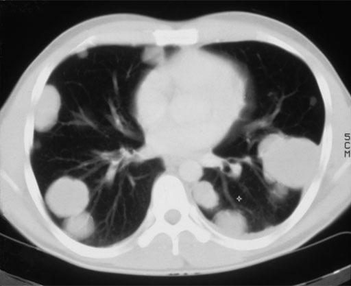 Seminoma és Non-Seminoma >/= Stage II C Seminoma és Non-Seminoma >/= Stage II C Kemoterápia!