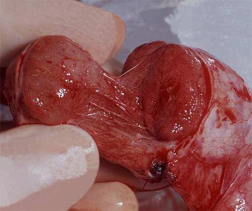 TIN ( testicularis intraepithel