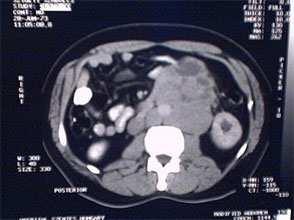 Képalkotók (Staging) Hasi és mellkas CT (Spiral CT) MRI kétség esetén Eszközös vizsgálatok UH-lokális, -hasi