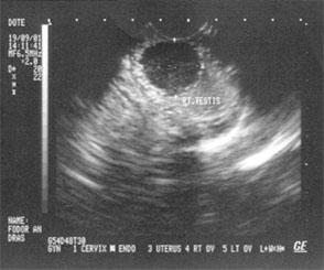 , tüdők, mediastinum PET kiegészítőként CT MR HERETUMOR PATHOLÓGIAI ÉS KLINIKAI STÁDIUMA (1996 WHO 1997)