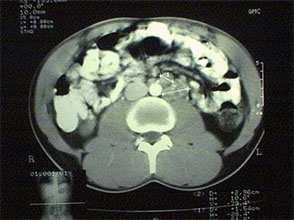 területeket és/vagy a mellékherét + vascularis lymphaticus érinvasio vagy a tumor a tunica albugineán túl