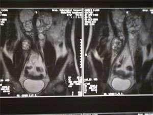 érinvasio pt4 A tumor a scrotumra terjed +/- vascularis lymphaticus érinvasio NX Regionalis nyirokcsomók nem