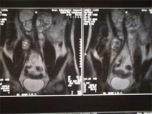 érinvasio pt4 A tumor a scrotumra terjed +/- vascularis lymphaticus érinvasio NX Regionalis nyirokcsomók nem