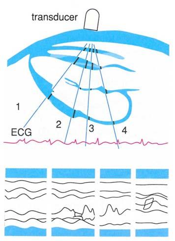 B-mode ECG signal or