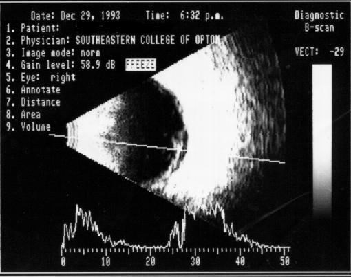 2-dimensional B-mode and A-mode (used in opthamology) Resolving limit, resolution real speed o propagation or the aurate determination o distanes: ornea: 1641 m/s aqueos humour: 1532 m/s rystalline