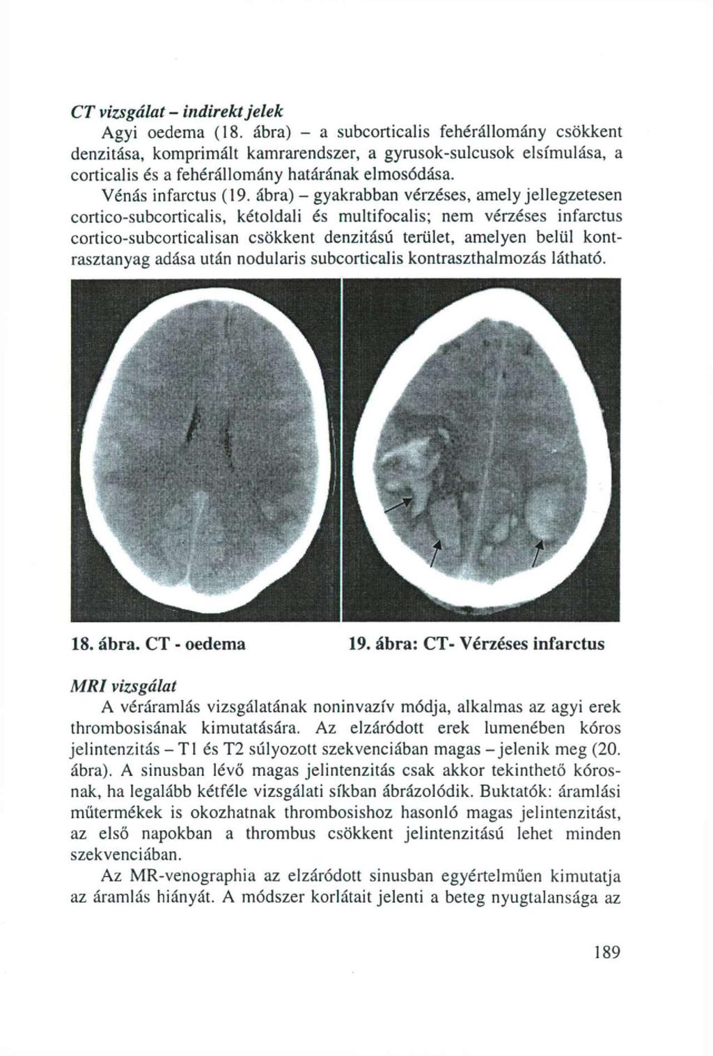 CT vizsgálat - indirekt jelek Agyi oedema (18.