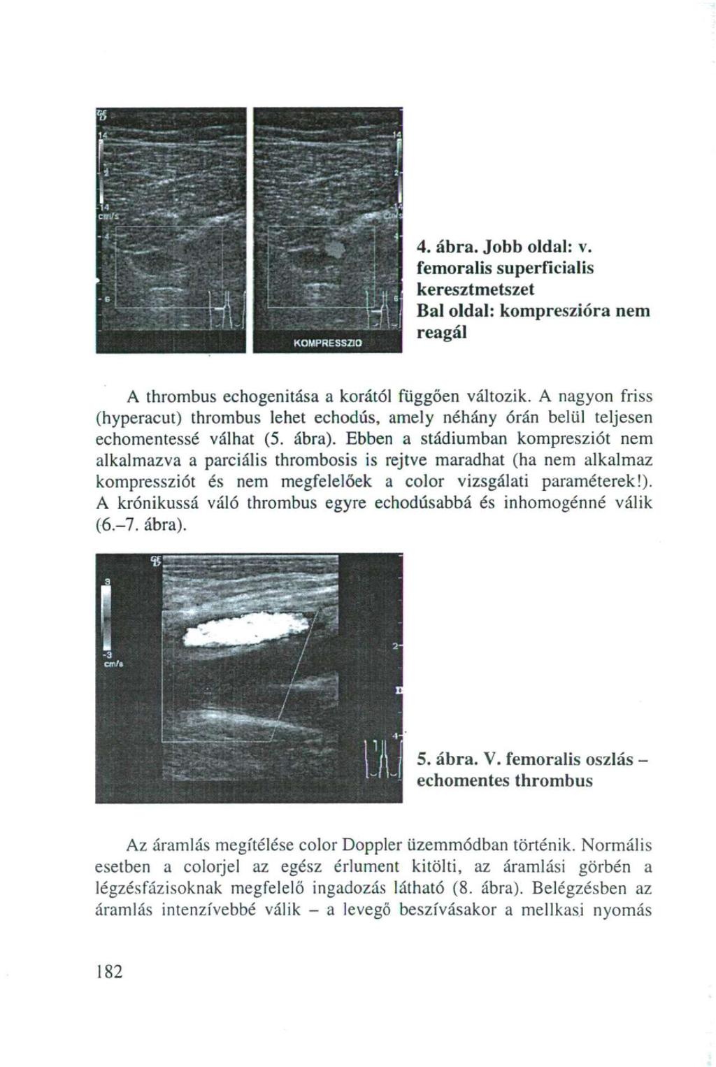 4. ábra. Jobb oldal: v. femoralis superficialis keresztmetszet Bal oldal: kompreszióra nem reagál A thrombus echogenitása a korától függően változik.