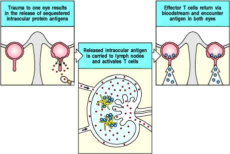 Immunológiailag privilegizált helyek sérülése autoimmun válaszhoz vezethet Egy szem sérülése következtében az üvegtest anyagából fehérjék jutnak a keringésbe Az effektor T sejtek visszajutnak a