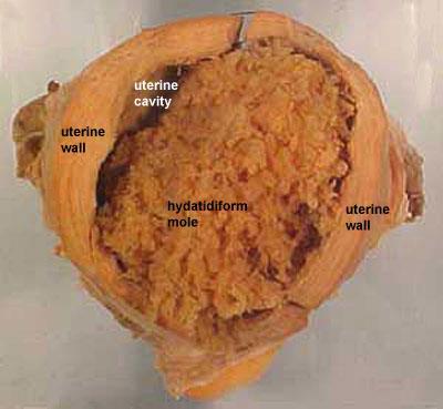 Terhességi trophoblast tumorok Hydatidiform Mola Hydatidiform Mola részleges (3n vagy 4n) vagy teljes mola (2n, csak apai genom) abnormális placenta, embrió részleges vagy hiányzik.