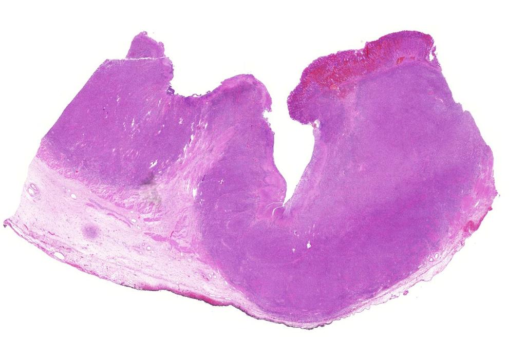 gyomor carcinoma) Blastos morfológia, sok