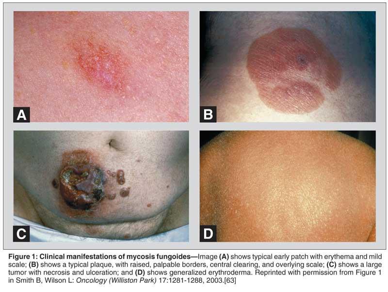 T-sejtek lymphomák Perifériás T-sejtes lymphoma Heterogén betegségcsoport Általában disszeminált Felnőttkori T-sejtes leukaemia/lymphoma Japán, Karibi térség, Közép-Afrika - endémiás HTLV-1