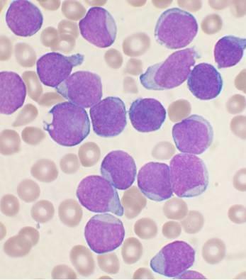 Akut leukaemia Elkülönítés LYMPHOID TdT :DNS polimeráz lymphoblast lymphocyta myeloblast Magi festődés MYELOID / MONOCYTAER MPO NSE :myeloperoxidáz Auer