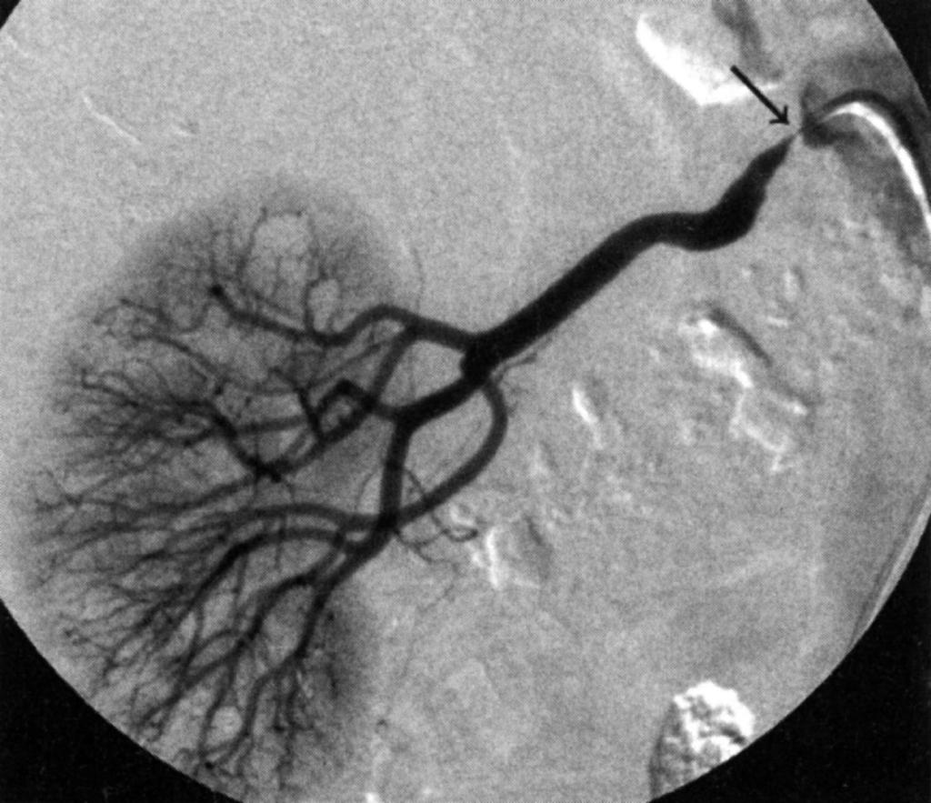 Veseartéri riák angiográfi fiás képe, a veseartéri riát az aorta felől