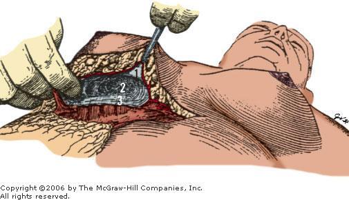 SPATIUM RETROMAMMARE 1. Retinacula cutis. 2. Membranous layer. 3. Serratus anterior fascia. 4.