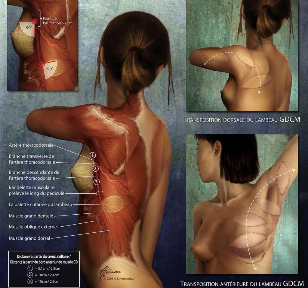 LATISSIMUS DORSI LEBENY Dr.