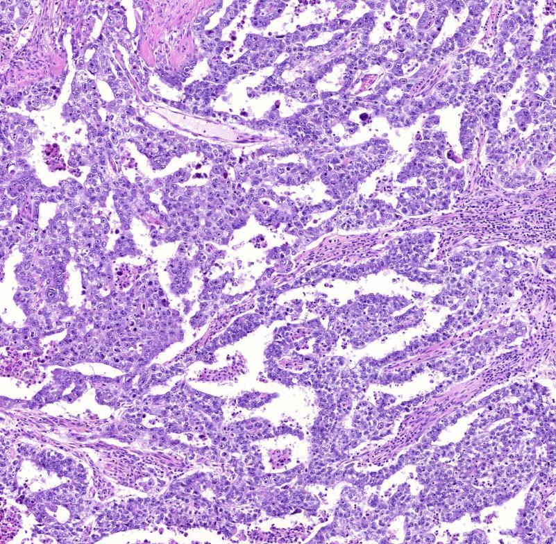 Embryonalis Carcinoma szolid, pseudoglanduláris, papilláris, alveoláris területek primitív epithelialis tumorsejtek,