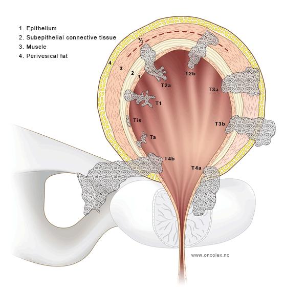 Urothelialis daganatok (T) 1. Epithel 2. Supepithelialis kötőszövet 3. Hólyagfali izomzat (belső és külső réteg) 4.