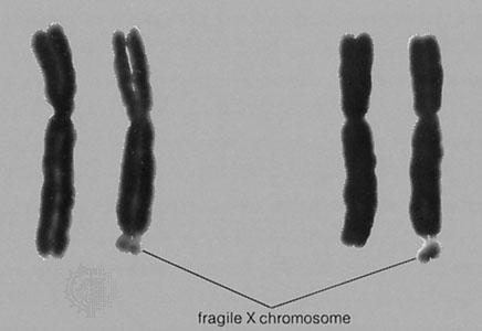 törékenységére, ezt követi a kromoszóma megjelölése ahol a fragilis helyet megfigyelték (X), az utolsó bető A pedig a hely megtalálási sorrendjére utal, minthogy ez volt az elsı fragilis hely, amit