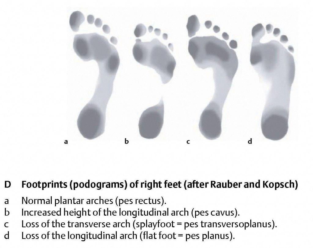 Lábboltozatok Lábnyomok különböző lábboltozatok esetén Normális lábboltozat (pes rectus) Kivájt láb - magas