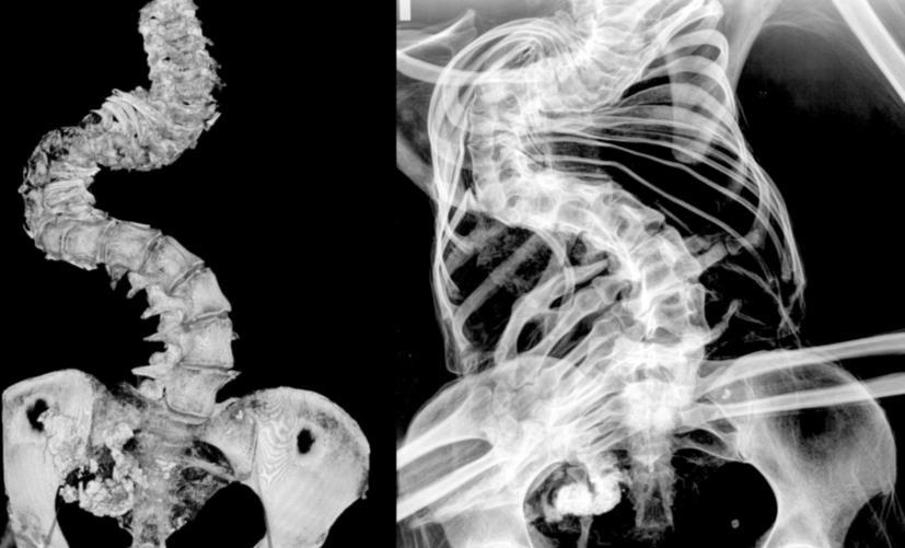 8. ábra: A röntgenfelvétel és a virtuális 3D-s rekonstrukció jól mutatja a nagymértékben deformálódott testet (97. számú múmia, Tauber Antónia). Fig.