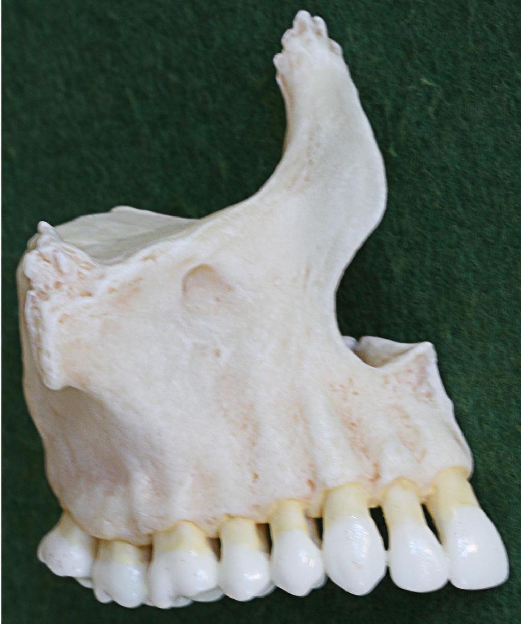 maxilla Facies anterior 1. Fossa canina 2. Foramen infraorbitale 3. Margo infraorbitalis 4. Incisura nasalis apertura piriformis 5.