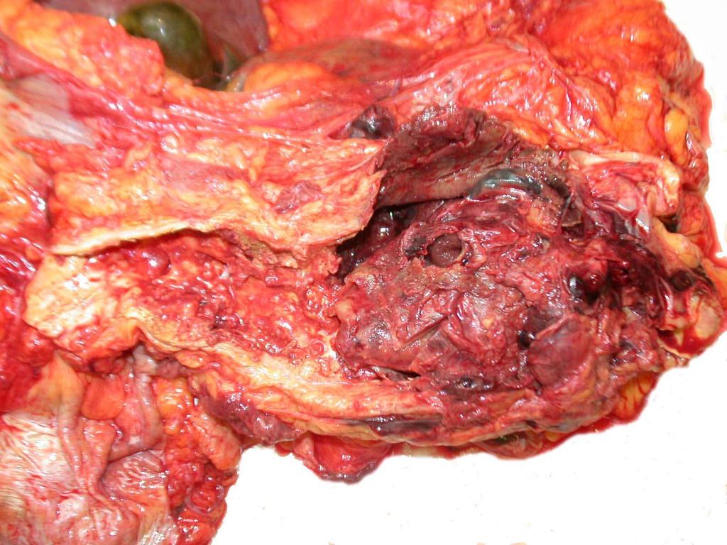 thrombosis Aorta