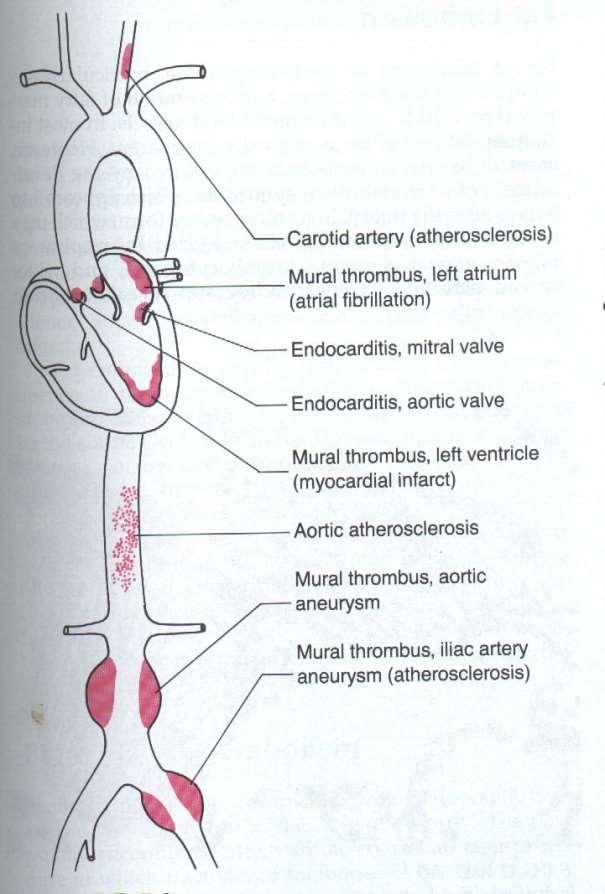 Thromboembolia 1.