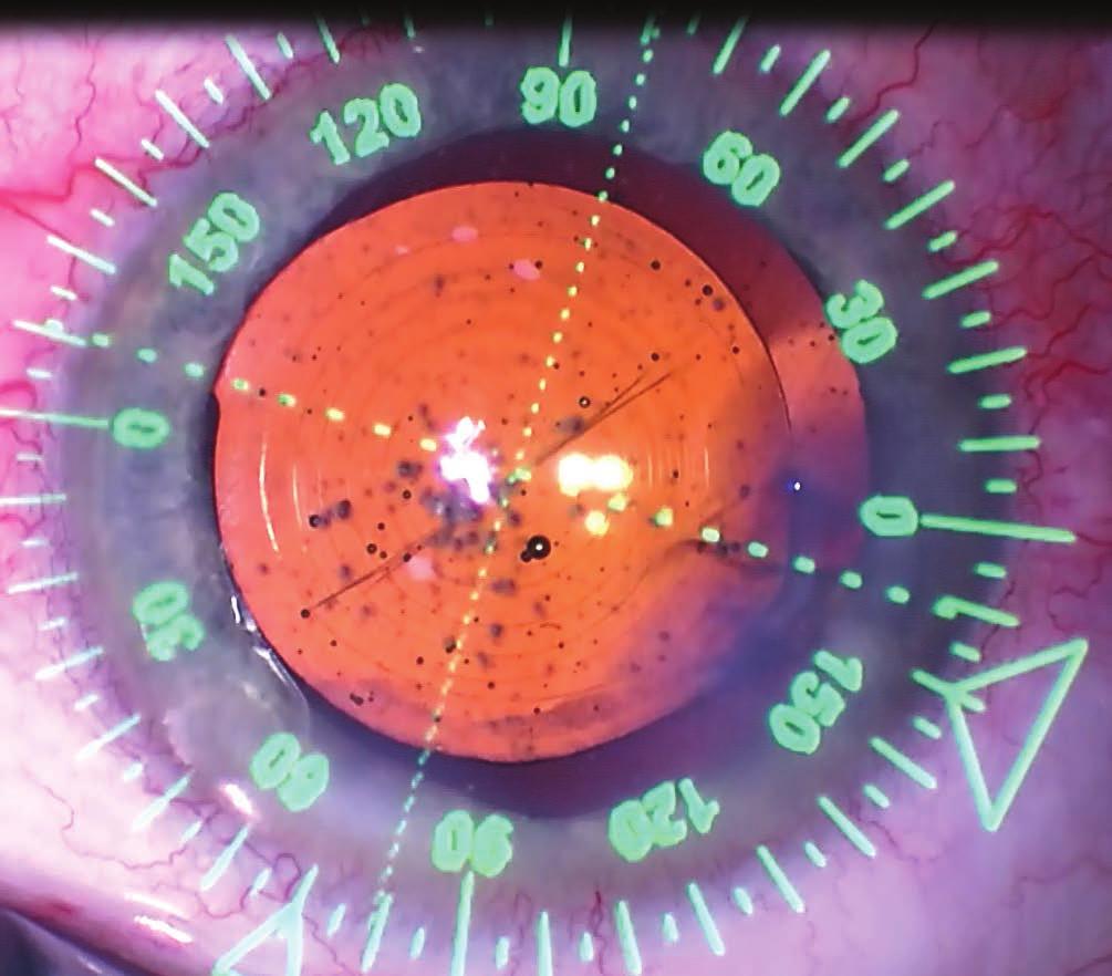 A vizsgálatok során a páciensről készített képet használva a szemet azonosítják a készülékek és ehhez igazítják a beállításokat, így nem fordulhat elő, hogy rossz szemet operálunk vagy hibás
