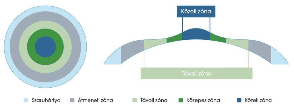 Monofokális (egyfókuszú) műlencse, ami a legegyszerűbb nagyítólencse, az Ön választása szerint vagy közelre, vagy távolra lehet vele jól látni. Más távolságra valószínűleg szemüveget kell viselnie.