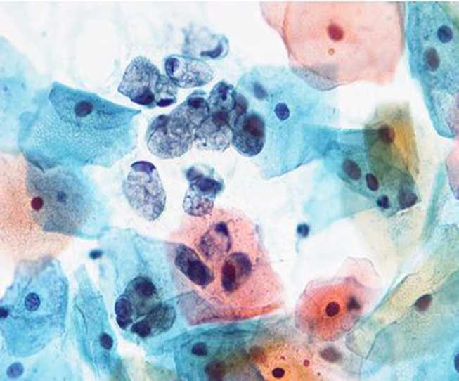 Papanicolaou festés sajátságai differenciált kontrasztfestés -a mag és a citoplazma jól elkülöníthető egymástól -a citoplazmát többféleképpen tudja megfesteni, a bazális rétegből származó