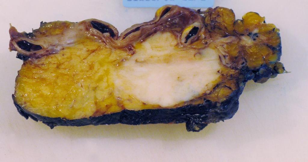 Pancreas adenocarcinoma Kép a SE