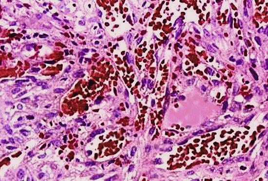 Főbb szövettani típusaik: Leiomyosarcoma Angiosarcoma Liposarcoma