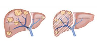 ALPPS (Associated Liver Partition and Portal vein ligation for Staged hepatectomy) ÚJ PVL + in