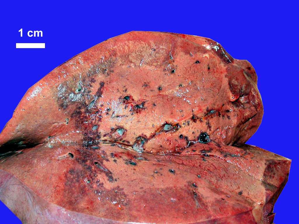 Forms of Focal Nodular Hyperplasia (X) Classic variant Not classic variants Teleangiectatic Mixed hyperplasticadenomatous Cytologic atypia Wanless et al.