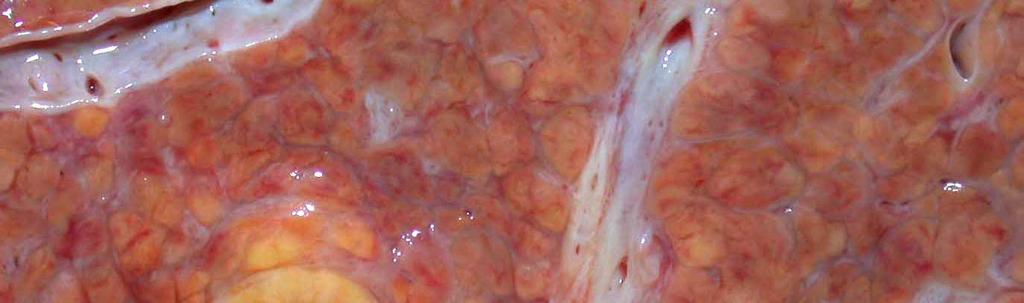 Lesions in Cirrhotic Liver Large Regenerative Nodule