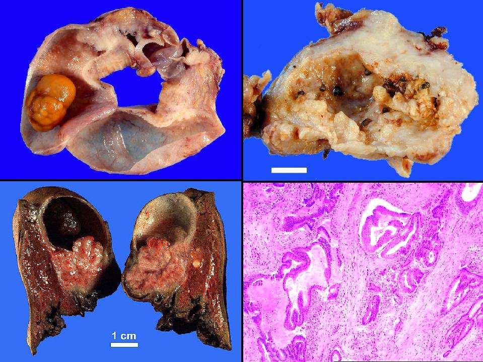 Epehólyag carcinoma jellemzői (**) Makroszkópos - infiltráció - exophyticus Hisztológia - adenocarcinoma Egyéb - TNM