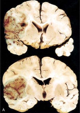 Colliquatios necrosis, cerebralis infarctus Encephalomalacia, agylágyulás, cerebralis infarctus Typusok: friss lágyulás (infarctus)