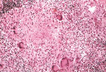 Caseatio (sajtos necrosis) tuberculosis (TBC) mellett, ami egy specificus, chronicus un.