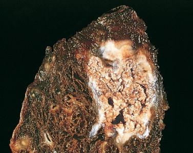 Caseatio: vagy sajtos necrosis (fehér, törékeny, necroticus szövet) Fénymikroszkóp: elsajtosodó granuloma