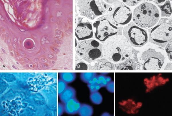 Apoptosis, morphologia Legjobban elektronmikroszkóppal látható Sejtzsugorodás: kisebb sejt, dens cytoplasma, organellumok normálisak) Chromatin kondenzáció: a legjellegzetesebb morphologiai vonása, a