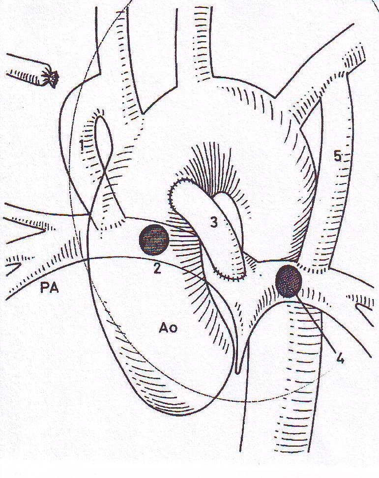 centrális shunt; (4) POTT s-anastomosis; (5) módosított