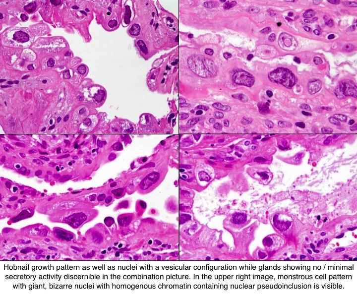 Az endometriumban: Arias-Stella