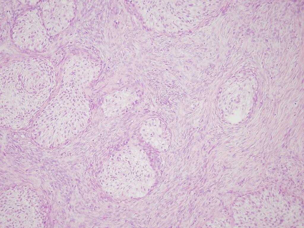 Brenner tumor Transitionalis