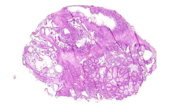Fagyasztott metszet cysticus ovarium tumor Differenciál