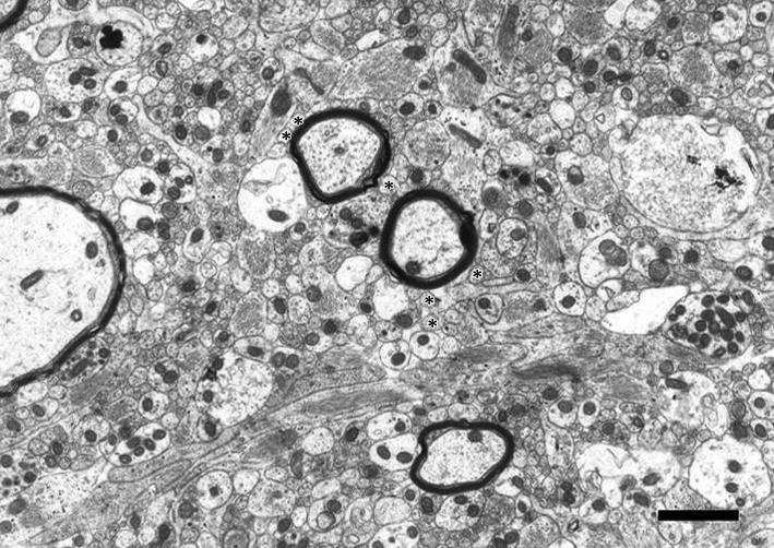 ábra). Feltőnı különbség volt a patkányban megfigyeltekkel szemben, hogy az astrocyta nyúlványok sőrőn egymás mellé préselt fibrillumokat tartalmaztak (47. ábra)